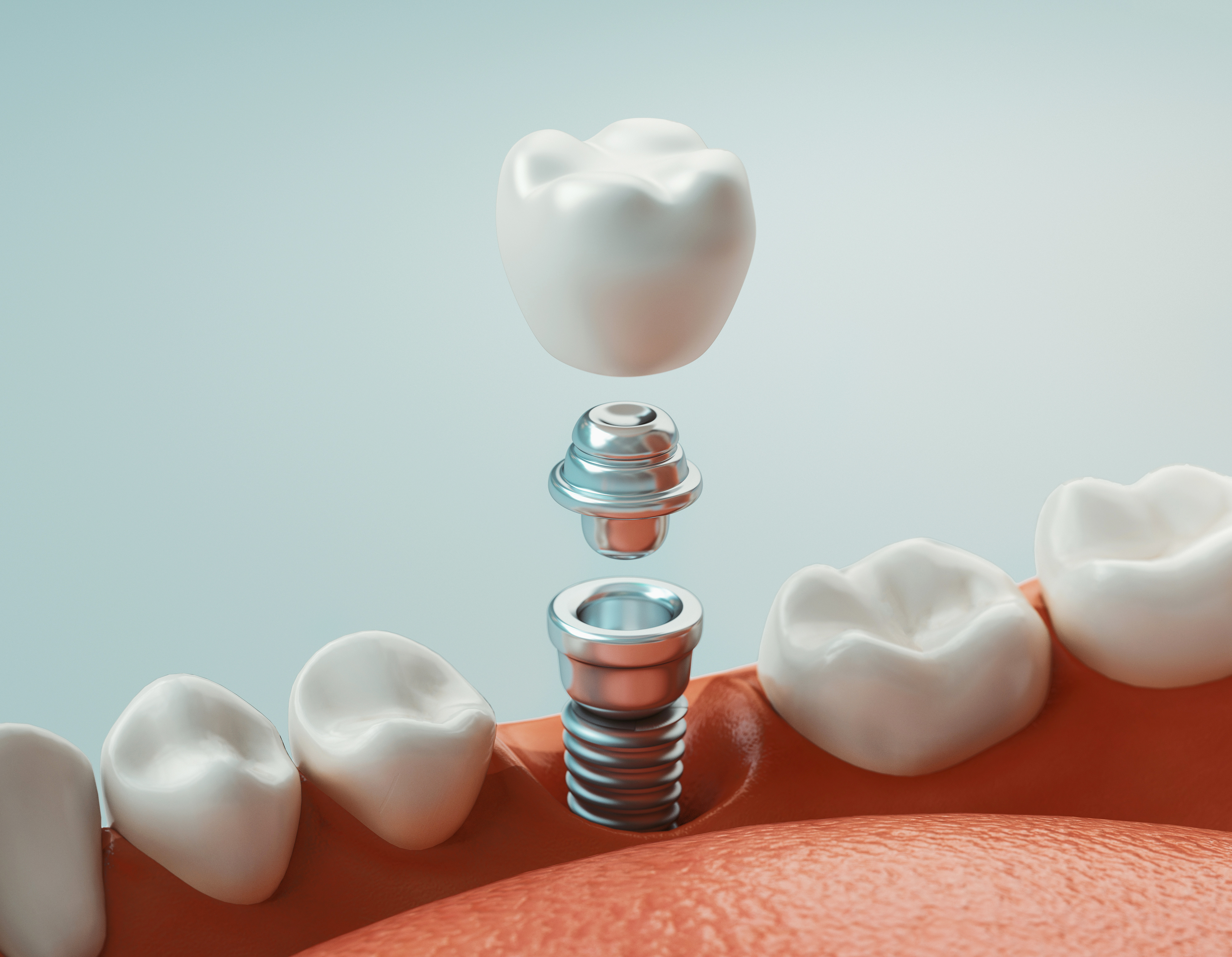 Computer-guided dental implant planning at Dogwood Family Dentistry