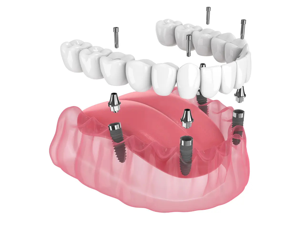 All-on-4 / Full-Arch Restoration at Dogwood Family Dentistry in Albemarle, NC