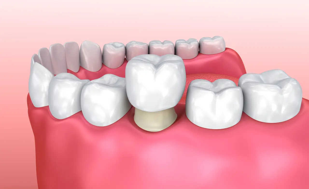 CEREC Same Day Dental Crowns in Albemarle NC