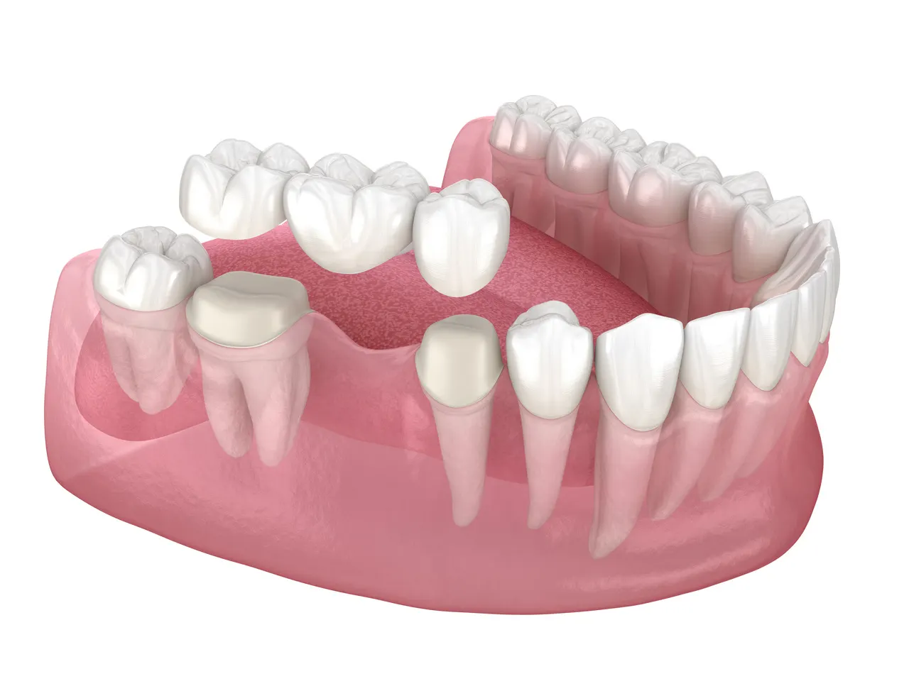 Dental Bridges at Dogwood Family Dentistry in Albemarle, NC